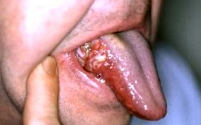 устната лигавица