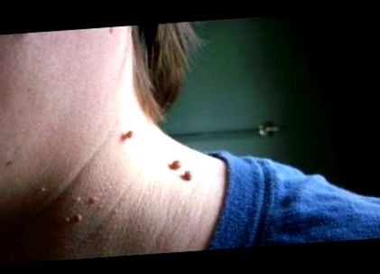 a papilloma nitrogénnel történő megszüntetése vitiligo bőrbetegség