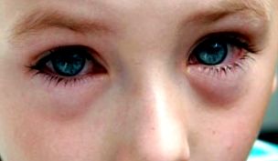 A szem alatti gyermek duzzanata - okai és kezelése