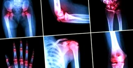 a cervicothoracalis osteochondrosis súlyosbodása térd feletti fájdalom
