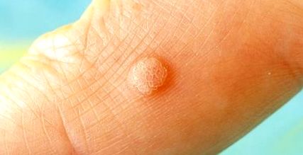 Humán papillomavírus fertőzés a könyökön