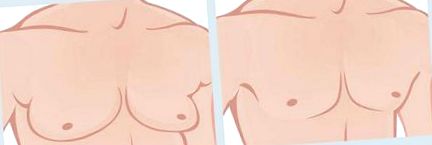 gynekomastia
