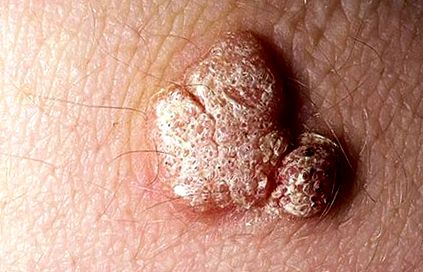 Papillomatosis bőrkiütés. A HPV (humán papillomavírus) fertőzés tünetei, kezelése
