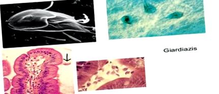 lamblia parazita tedavisi hpv szemölcs és rák