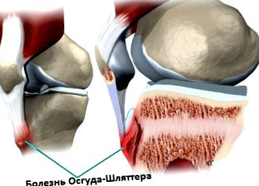 a térdízület posztraumás artrózisa