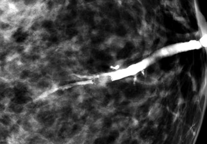 nyálmirigyek intraductalis papilloma