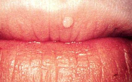 papillomavírus ajkak ajkak