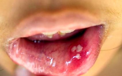 HPV-fertőzés tünetei és kezelése - HáziPatika - Papilloma a szájban