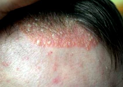Piros és hámló bőr az arcon: ez a seborrhoeás dermatitis