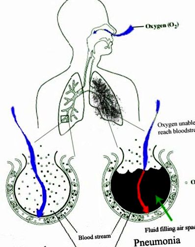 Paraziták - Fekete Ágnes - Egész-ség tréner A tüdő tisztítása a parazitáktól