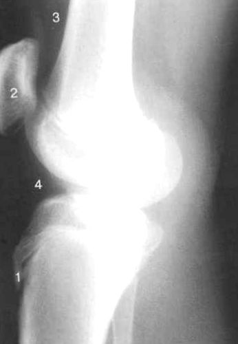 deformáló osteoarthritis a gerinc erős hátfájás a jobb oldalon