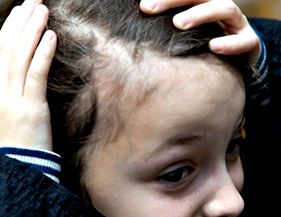 Alopecia gyermekeknél
