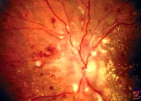 hipertóniás szem angiopathia)
