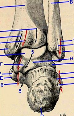 3. fokozatú osteoarthritis