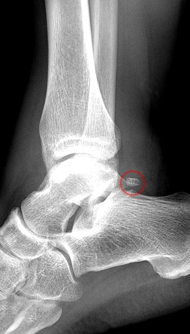 Osteoarthritis of the ankle: methods for joint-preservation