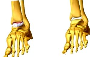 Bokaízület fájdalom, mit kell tenni, Hogyan zajlik a lábfej fájdalom kezelése