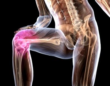 Aki kezeli a lábak kis ízületeinek osteoarthrosisát Gyógyszer a lábujj artrózisához