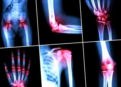 deformált osteoarthritis és kezelése