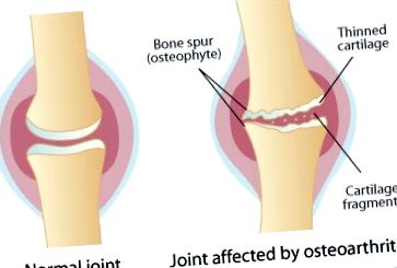 Csípő osteoarthritis és kezelése, Izmok és ízületek