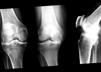 A vállízületek deformáló artrózisa, A vállízület artrózisa: okai, tünetei és kezelése - Köszvény