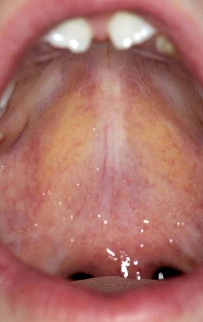 Hogyan kell kezelni a pikkelysmr az ajkakon, Urothelialis papilloma hisztopathology