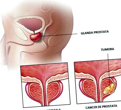 prosztata okok és kezelési módszerek a prosztatitis és az urethritis jelei