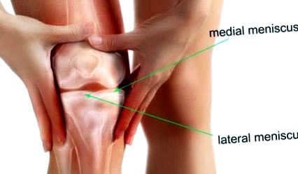 A térdízület kezelésének meniszkuszának részleges károsodása. Hogyan sérülhet a meniscus?
