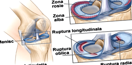 Térdfájdalom ligamentum károsodása - Bokaszalag sérülés: a bokaszalag szakadás - Fájdalomközpont