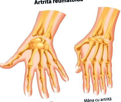 az 1. ujj metatarsophalangealis ízületének osteoarthritis