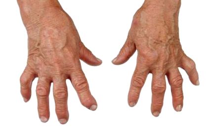 kezelje az ujj falanx ízületét kenőcs a csontkovács alatt a csontritkulásról