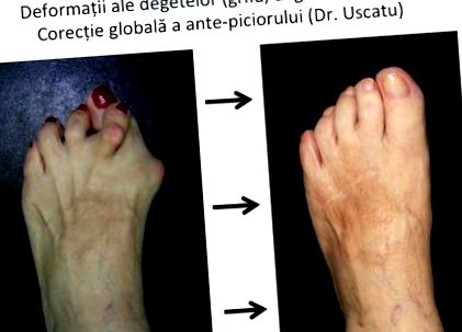 Dr. Diag - Kisízületi arthrosisok a kézen, A lábközi interphalangealis artrosis