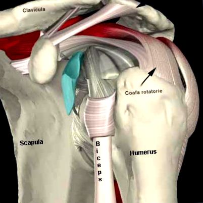 A vállízület deformáló artrózisa 3 fok