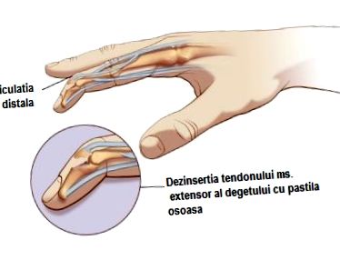 fájdalom az ujjak ízületeiben melyik orvos térdízületi ízületi gyulladás tünetei