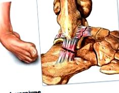 a boka ízületének 3 fokú csontritkulása ízületi fájdalom és duzzanat a karokban