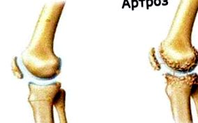 A térd osteoarthritis kezelését okozza