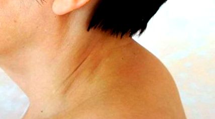 A nyaki gerinc osteokondrozisának leghatékonyabb gyógyszere, A nyaki problémák okai és kezelésük