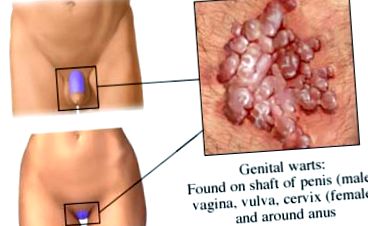 a vulva és a hüvely genitális szemölcsei