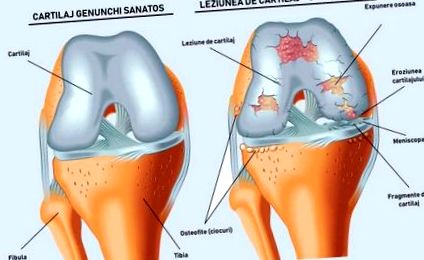 2 fokozatú osteoarthritis a térdízület következményeiről