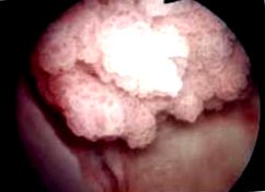 Tehát hólyag-papilloma Húgyhólyag daganat | Urológiai Klinika