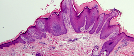 Hyperkeratosis papilloma, A nőgyógyászati leletek jelentése és értelmezése I.