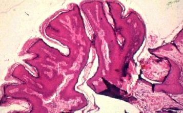 hyperkeratosis bőr papilloma a helmint paraziták példák