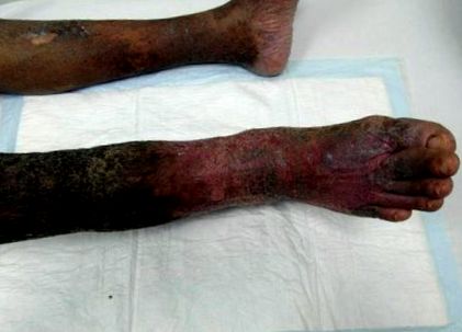 Warts on skin icd 10, Wart virus icd Papilloma of icd 10