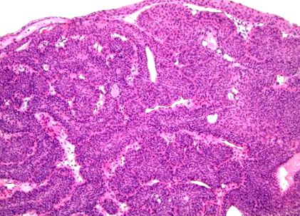 intraductal papilloma sonography
