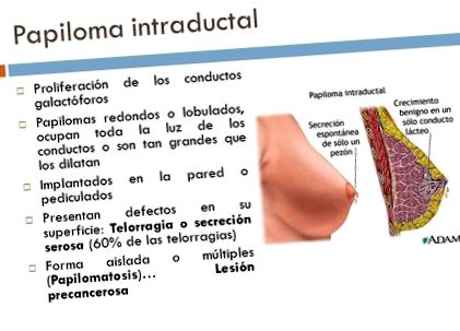 intraductalis papilloma a mellben