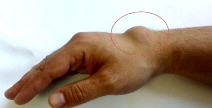 A kéz osteoarthritise