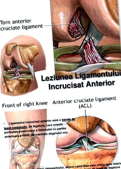 térdízület kezelés hátsó keresztszalagjának repedése kenőcs a lábujjak ízületeinek artritiszére