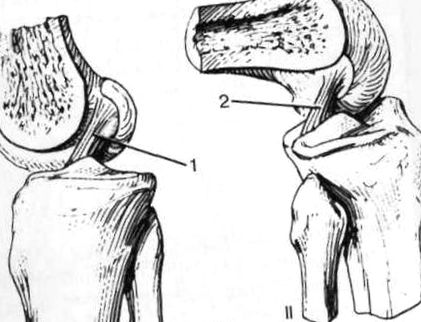 a térd keresztezett szalagjai károsodásának tünetei a lábujjak ízületeinek kezelése