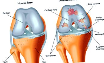 Artrózis a láb második fokának, A térd deformáló artrózisa 3 fok
