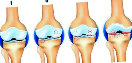 deformáló osteoarthritis az 1. fokú kezelés