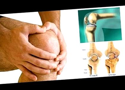 a bordaízületek osteoarthritis görcsös fájdalom a bokában